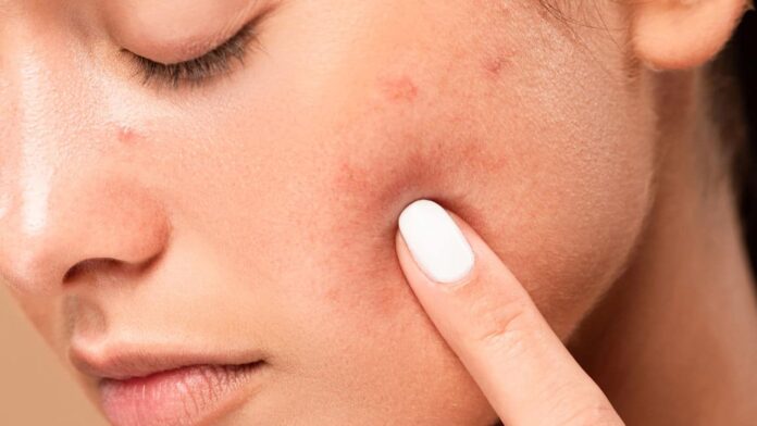 o-melhor-tratamento-para-manchas-da-pele-de-acordo-com-os-dermatologistas